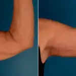 تجربتي مع شد الزنود بالليزر