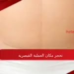 أسباب تحجر مكان العملية القيصرية