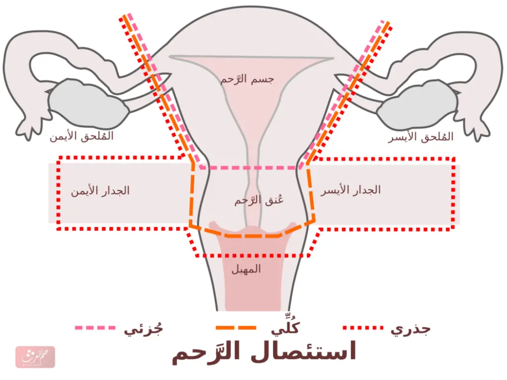اين يذهب ماء الرجل بعد استئصال الرحم وما تأثيره علي الزوجة