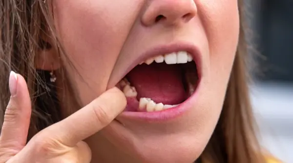 هل بلع الدم بعد خلع الضرس مضر ومدى تأثيره علي الجسم