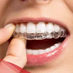 تجربتي مع التقويم الشفاف وأهم عيوب ومميزات التقويم المتحرك