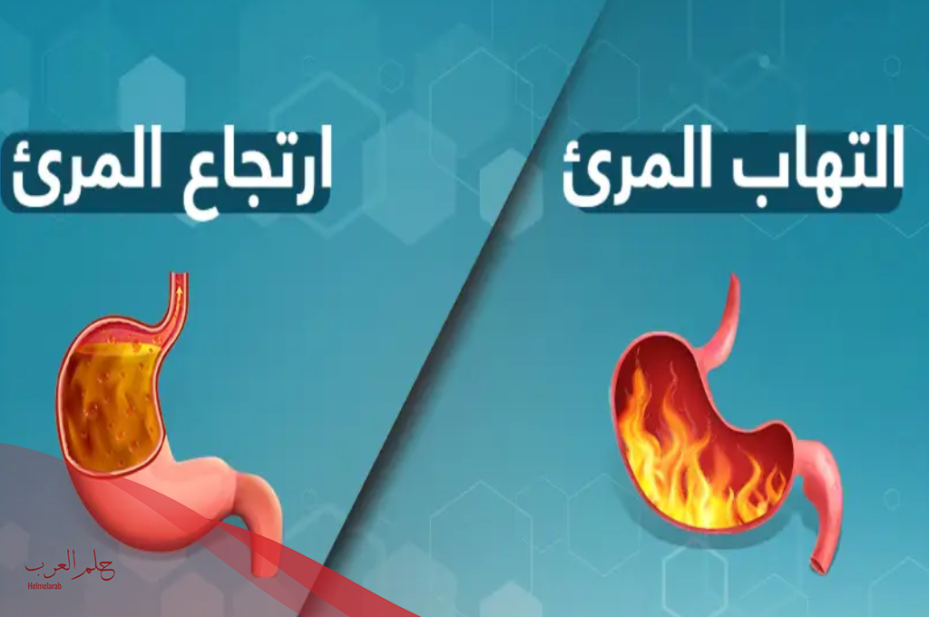 تجربتي مع التهاب المريء ومدة علاجه، وهل هو خطير