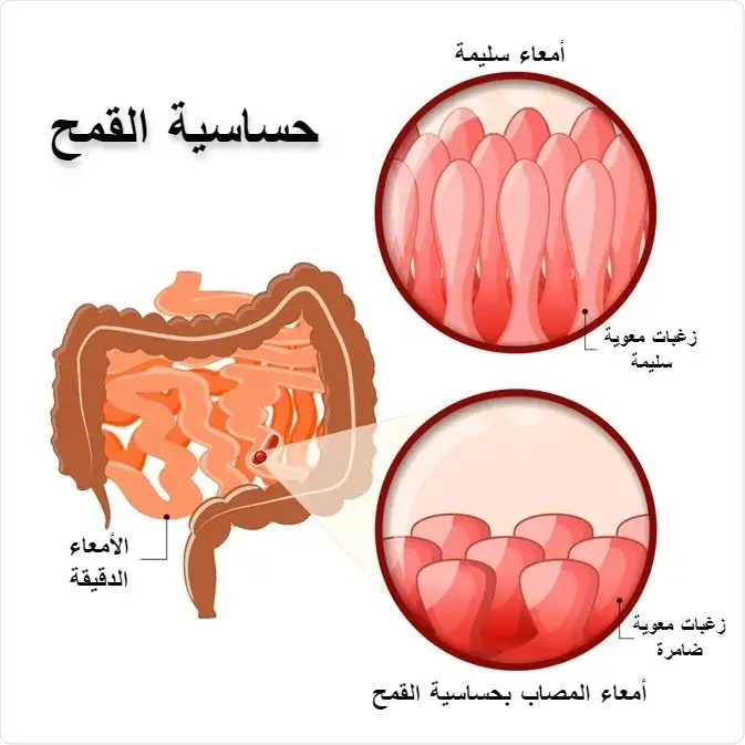 علاج حساسية القمح جابر القحطاني | تجارب حقيقة