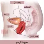 تجربتي مع هبوط المهبل وكيفية علاجه في المنزل