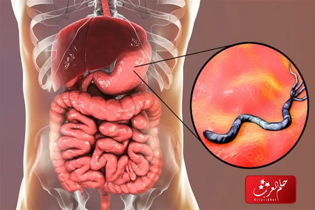 الحمدلله شفيت من جرثومة المعدة .. حالات شفيت من الجرثومه بوقت قصير