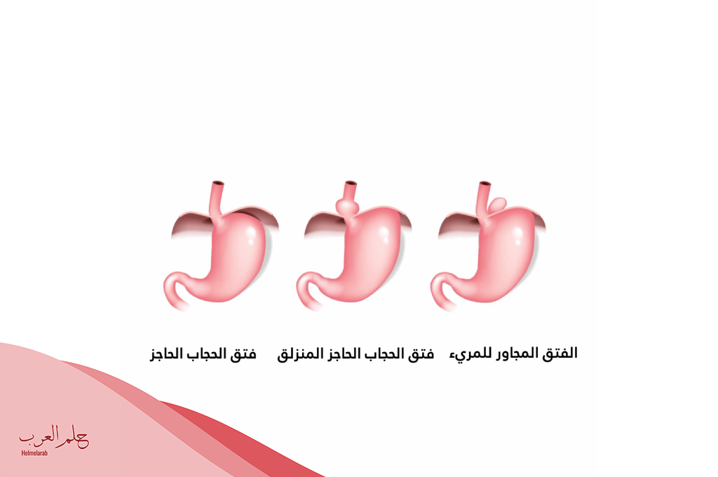 تجربتي مع فتق الحجاب الحاجز وأهم اعراضه