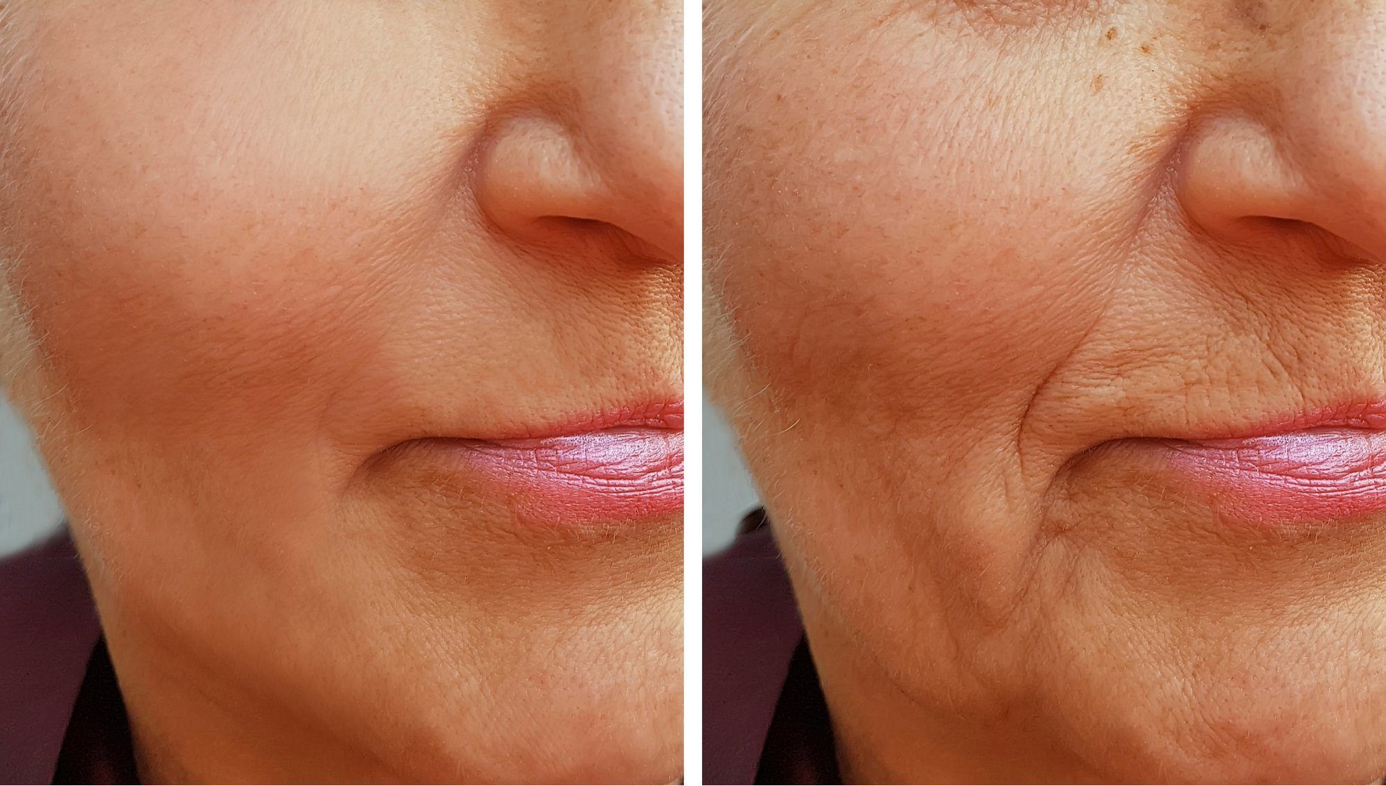 سعر حقنة botox في السعودية وما هي آثارها السلبيه