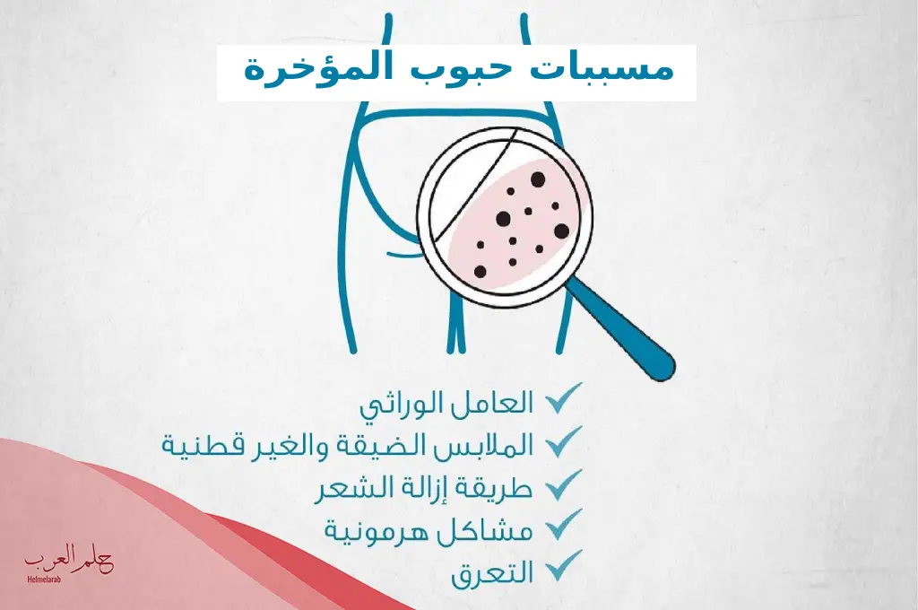 طريقة التخلص من حبوب المؤخرة وتبييضها