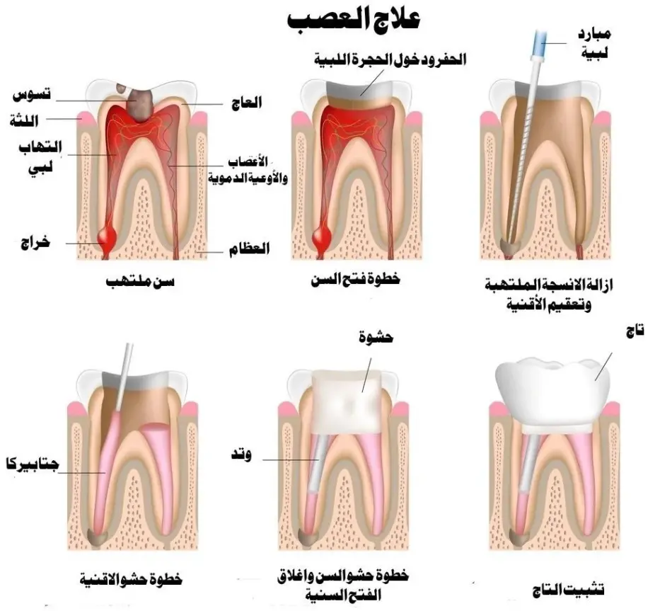 كيفية تمويت عصب الضرس في المنزل بدون الم بطريقة مجربة