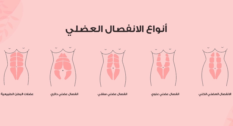 تجربتي مع انفصال عضلات البطن، و5 تمارين لعلاجه
