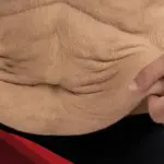 الترهل بعد التكميم، 5 طرق للحفاظ على الجسم من الترهلات