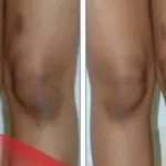تجربتي مع سواد الركب وكيف تتخلص منه