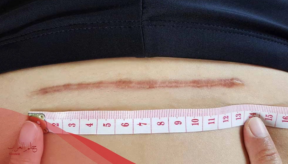 جرح العملية القيصرية يحرقني .. أسبابه وطريقة علاجه