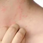 تجربتي مع الارتكاريا وكيفية علاجها