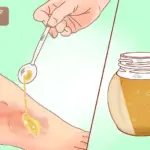 تجربتي مع العسل للحروق وطريقة استخدامه