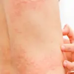 علاج مرض الشرى نهائيا في المنزل بالاعشاب
