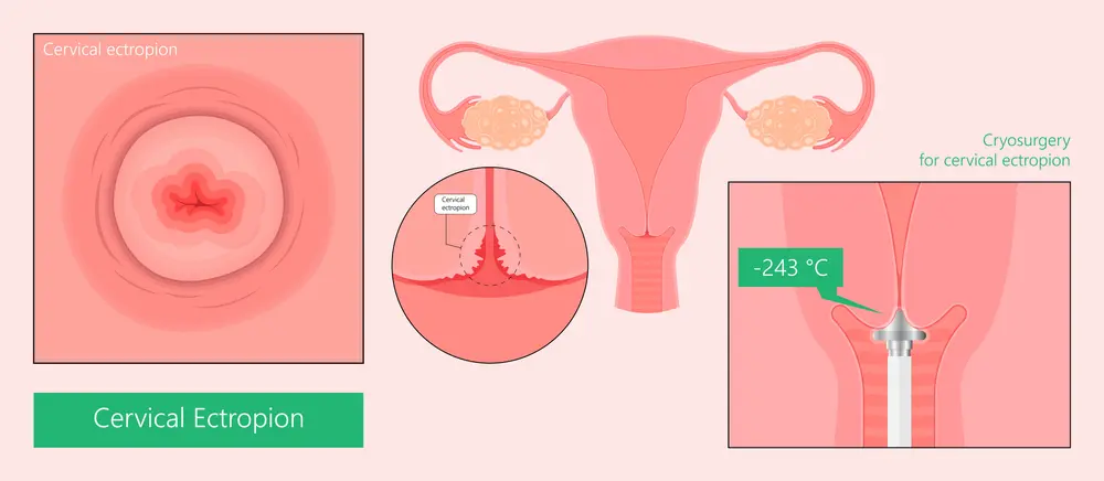 علاج قرحة عنق الرحم بالتحاميل