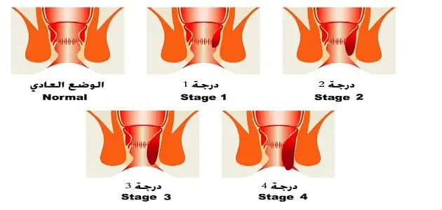 شكل البواسير الخارجية بالصور الحقيقية وكيفية التخلص منها