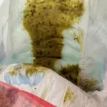 خيوط سوداء في براز الرضيع أسبابها وكيفية علاجها