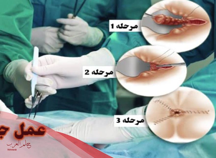 كم يستمر الالم بعد عملية البواسير