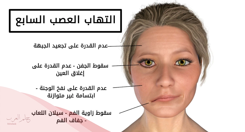 قائمة الاكل الممنوع لمرض العصب السابع