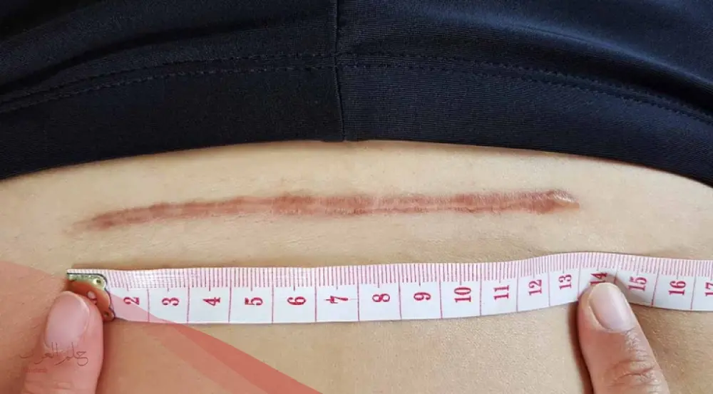 أسباب خروج سائل من جرح العملية القيصرية : 5 نصائح يجب معرفتها