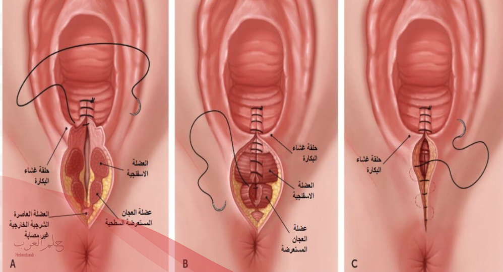 هل يلتئم جرح العجان بدون خياطه