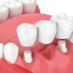 تجربتي مع جسر الاسنان وما هي عيوبه