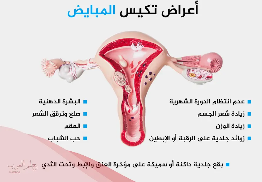 هل يزول تكيس المبايض بعد الحمل