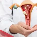 هل يزول تكيس المبايض بعد الحمل