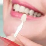 تجربتي مع عدسات الاسنان، المميزات والعيوب وهل هي مؤلمة؟