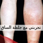 تجربتي مع جلطة الساق: كيفية علاجها وأبرز علامات الشفاء