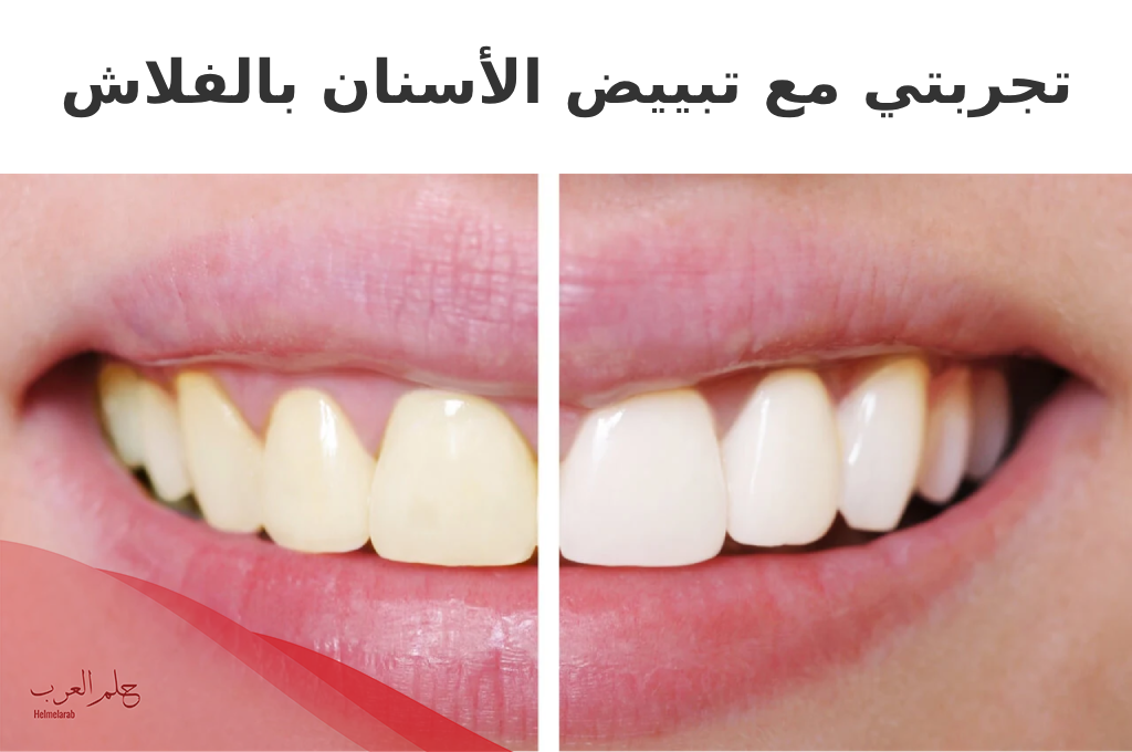 تجربتي مع تبييض الأسنان بالفلاش، مميزاته وعيوبه ونتائجه