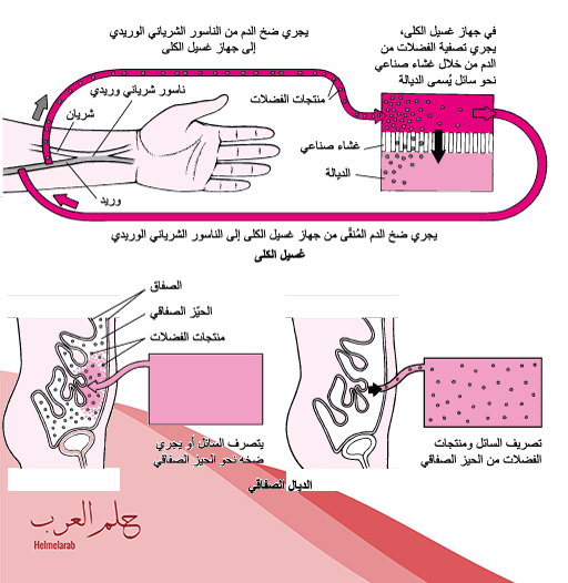 تجربتي مع الغسيل البريتوني ومعلومات عن أهم الانواع والأضرار