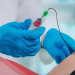 تجربتي مع الفصد وما هي الأمراض التي يعالجها