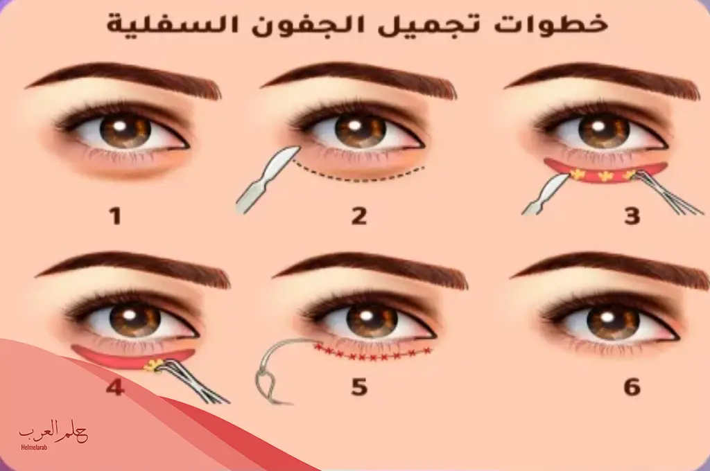 تجربتي مع عملية شد الجفون، مخاطر عملية شد الجفون وهل مؤلمة؟