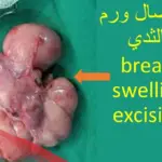 تجاربكم مع عملية استئصال ورم حميد من الثدي
