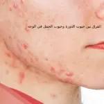 الفرق بين حبوب الدورة وحبوب الحمل في الوجه