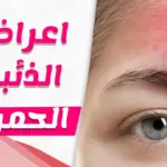 تجربتي مع الذئبة الحمراء: أسبابها واعراضها وكيفية علاجها