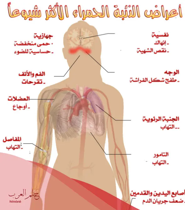 تجربتي مع الذئبة الحمراء: أسبابها واعراضها وكيفية علاجها