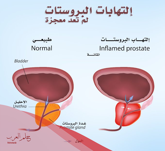 علاج التهاب المثانة بالأعشاب مجرب