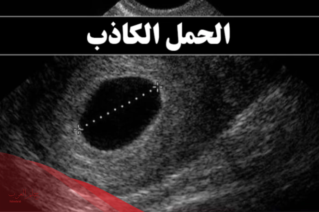 تجربتي مع الحمل بكيس بدون جنين 