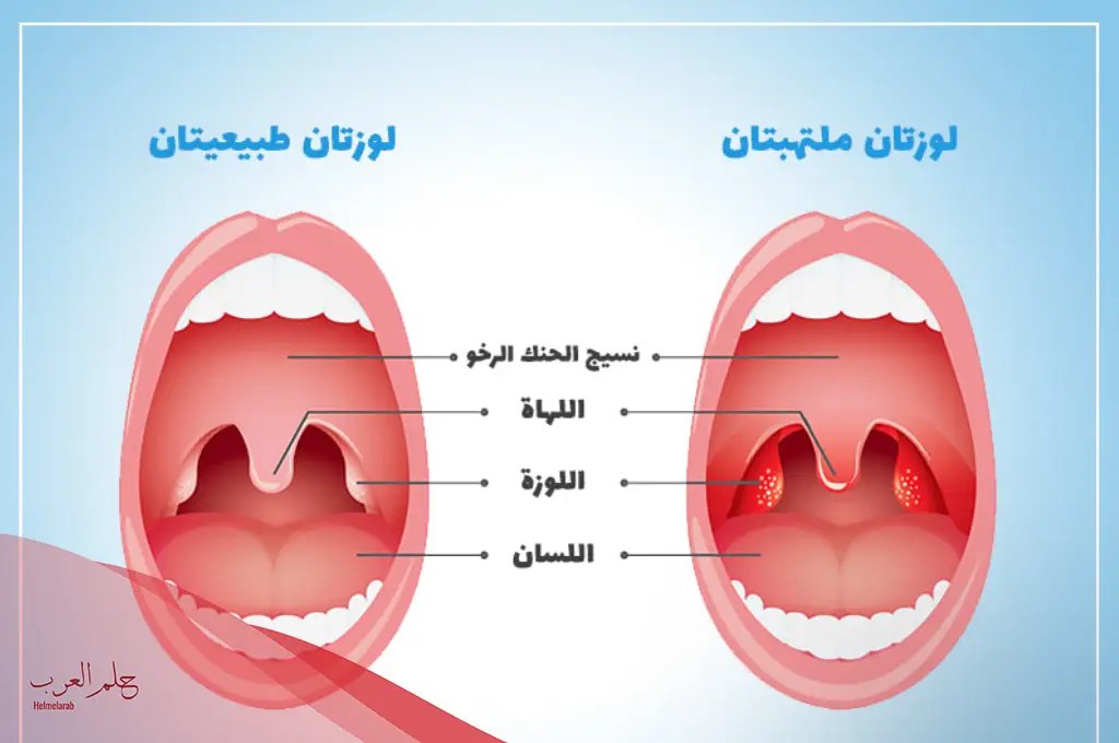 تجربتي مع استئصال اللوزتين للاطفال وما سلبيات ازالة اللوزتين؟