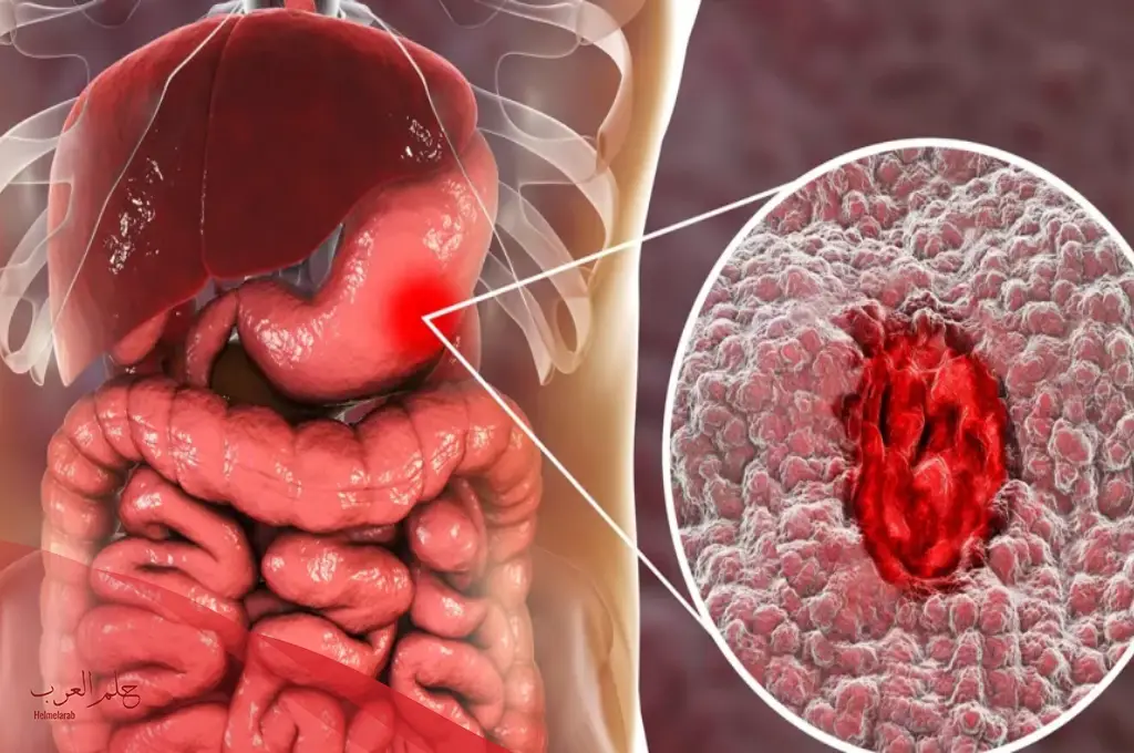 تجربتي في علاج قرحة المعدة وكيفية علاجها نهائياً