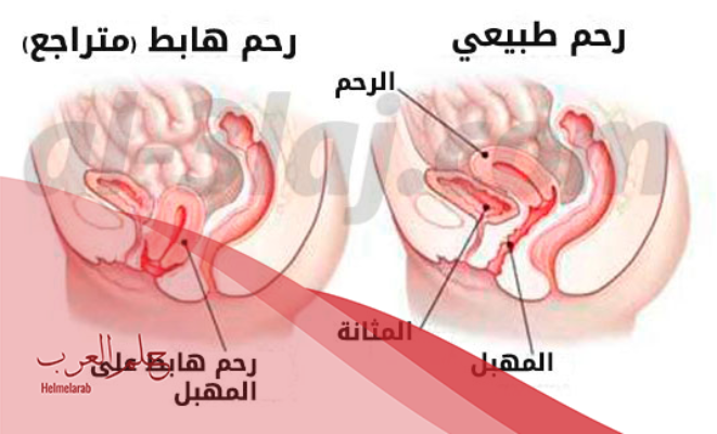 علاج هبوط المثانة بدون جراحة