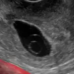 علاج الحمل بكيس فارغ بالقران