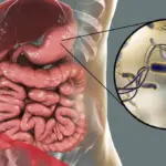 تجربتي مع جرثومة المعدة وطريقة علاجها بالاعشاب