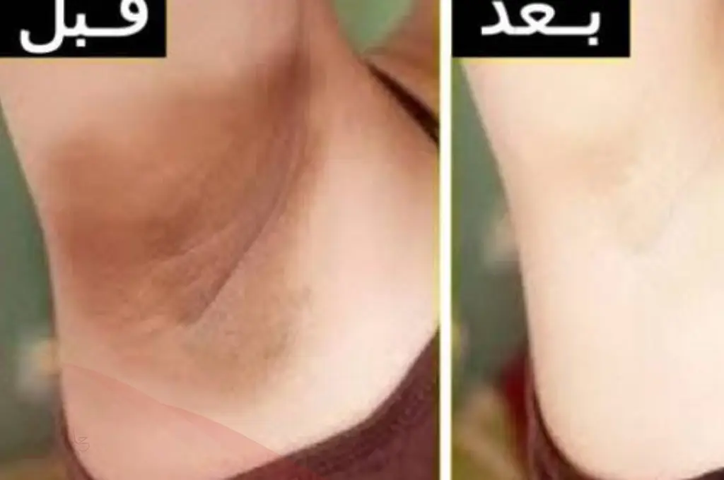 تجربتي الناجحه في تبييض الابط