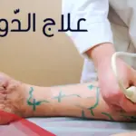 تكلفة علاج الدوالي بالليزر في السعودية 1446 وأفضل دكتور