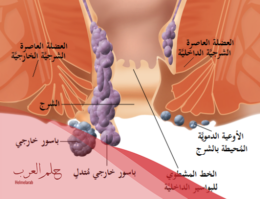 تجاربكم مع البواسير بعد الولاده: الأسباب وطريقة العلاج